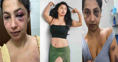 Actress Anika Vikraman accuses ex-boyfriend of physical, mental abuse; shared injury photos